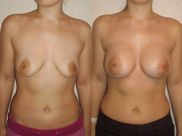 Увеличение птозированной груди